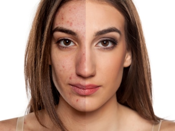 Imagem de Tratamento de Acne Na mulher adulta